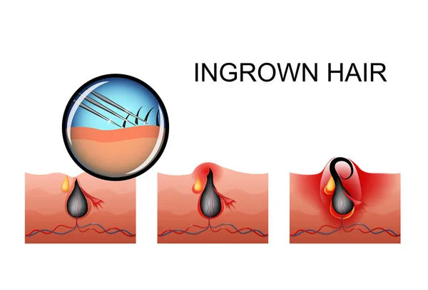 Dealing with Ingrown Hairs after Using Hair Removal Cream: Prevention and Treatment